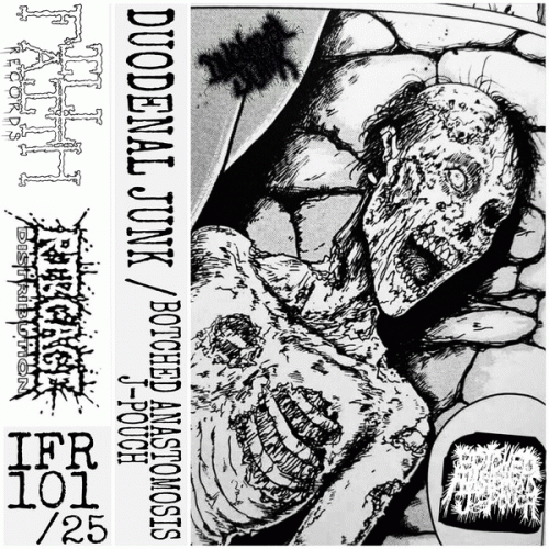 Botched Anastomosis J-Pouch : Duodenal Junk - Botched Anastomosis J-Pouch